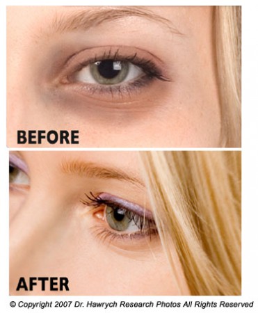 Removing Dark Circles under eyes